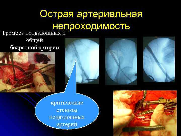 Острая артериальная непроходимость Тромбоз подвздошных и общей бедренной артерии критические стенозы подвздошных артерий 