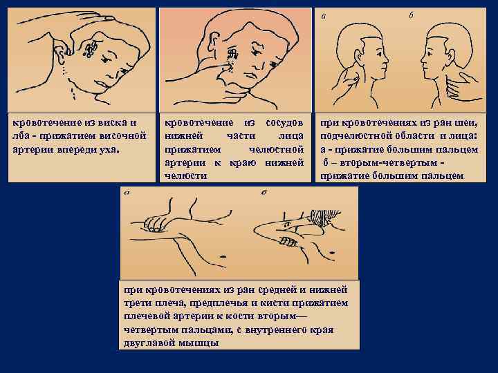 кровотечение из виска и лба - прижатием височной артерии впереди уха. кровотечение из сосудов