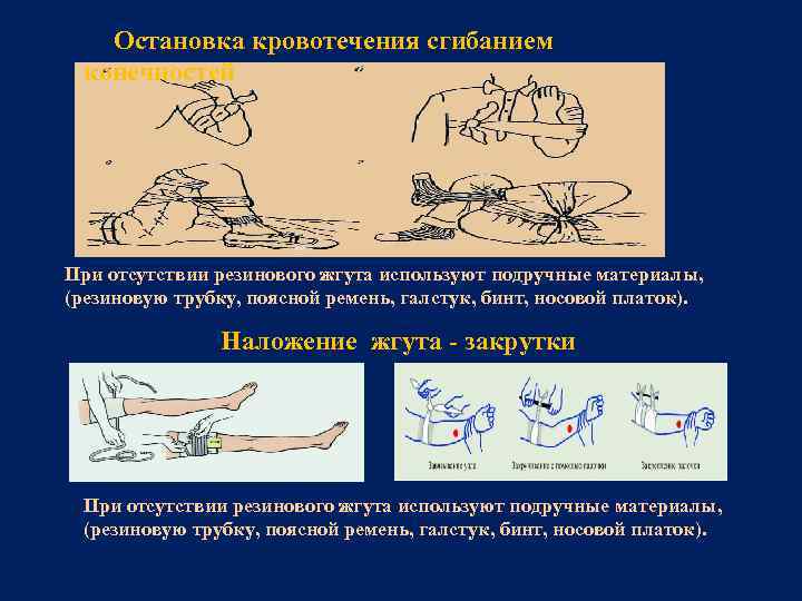  Остановка кровотечения сгибанием конечностей При отсутствии резинового жгута используют подручные материалы, (резиновую трубку,