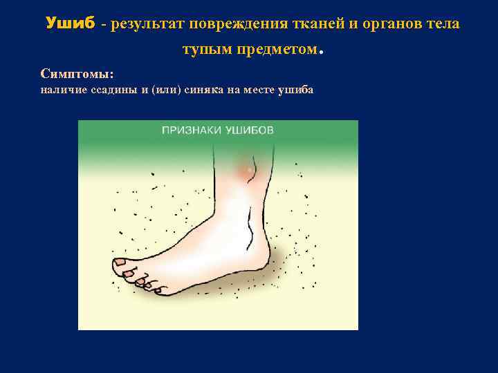 Ушиб - результат повреждения тканей и органов тела тупым предметом. Симптомы: наличие ссадины и