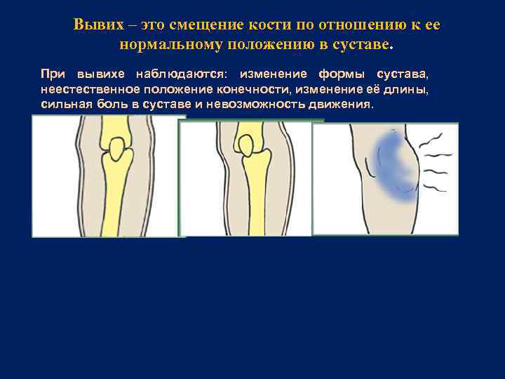 Вывих – это смещение кости по отношению к ее нормальному положению в суставе. При