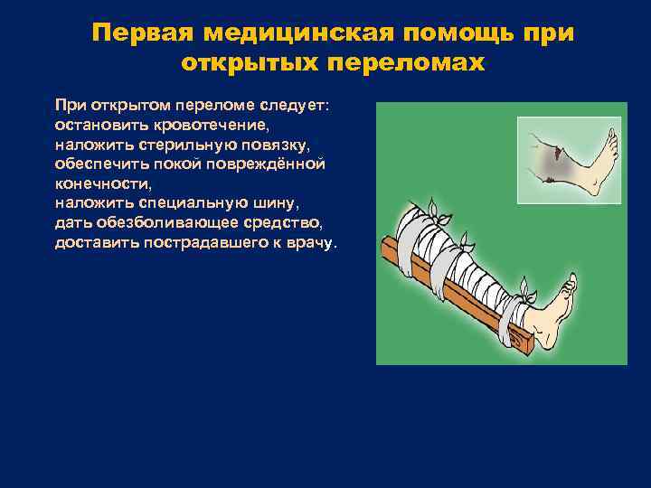 Первая медицинская помощь при открытых переломах При открытом переломе следует: остановить кровотечение, наложить стерильную