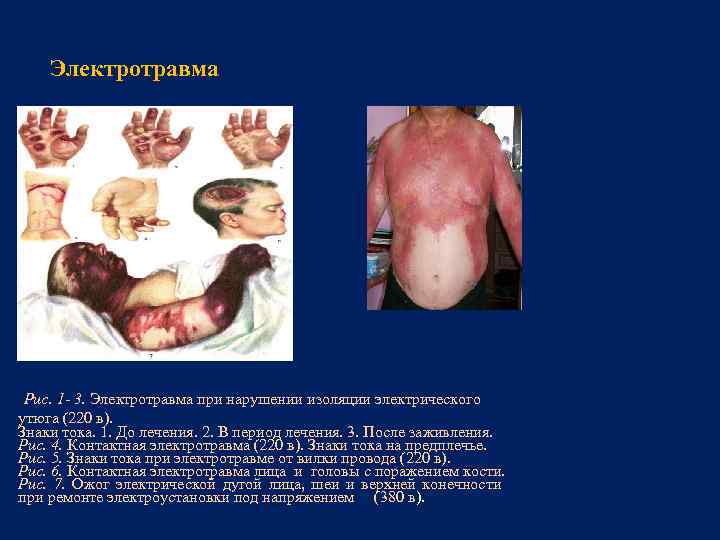 Электротравма Рис. 1 - 3. Электротравма при нарушении изоляции электрического утюга (220 в). Знаки