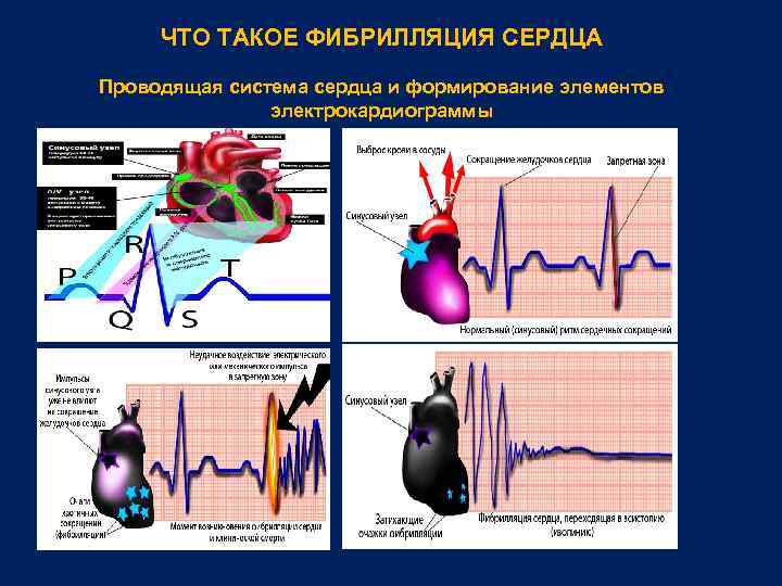 ЧТО ТАКОЕ ФИБРИЛЛЯЦИЯ СЕРДЦА Проводящая система сердца и формирование элементов электрокардиограммы 