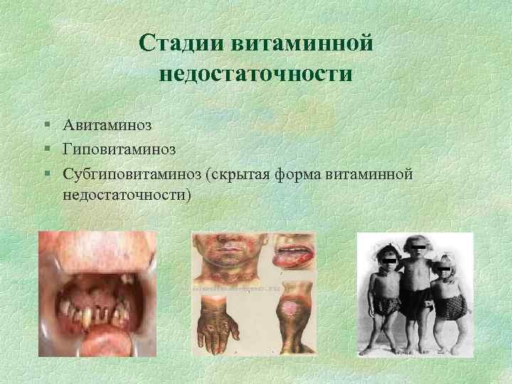 Стадии витаминной недостаточности § Авитаминоз § Гиповитаминоз § Субгиповитаминоз (скрытая форма витаминной недостаточности) 
