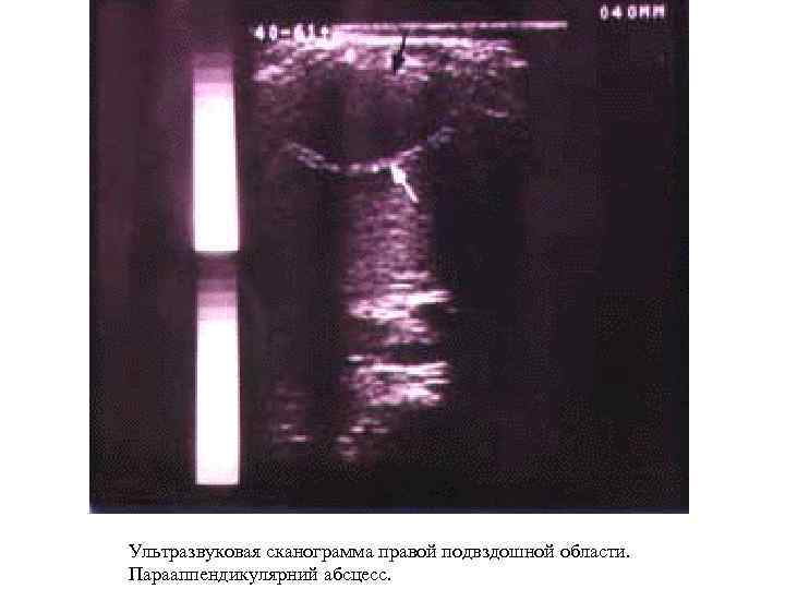 Ультразвуковая сканограмма правой подвздошной области. Парааппендикулярний абсцесс. 