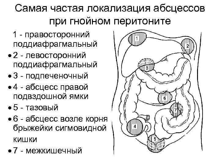 Самая частая локализация абсцессов при гнойном перитоните 1 - правосторонний поддиафрагмальный · 2 -