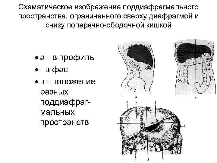 Схематическое изображение поддиафрагмального пространства, ограниченного сверху диафрагмой и снизу поперечно-ободочной кишкой · а -