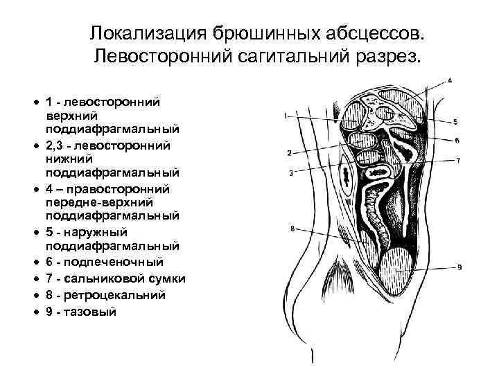 Локализация брюшинных абсцессов. Левосторонний сагитальний разрез. · 1 - левосторонний верхний поддиафрагмальный · 2,