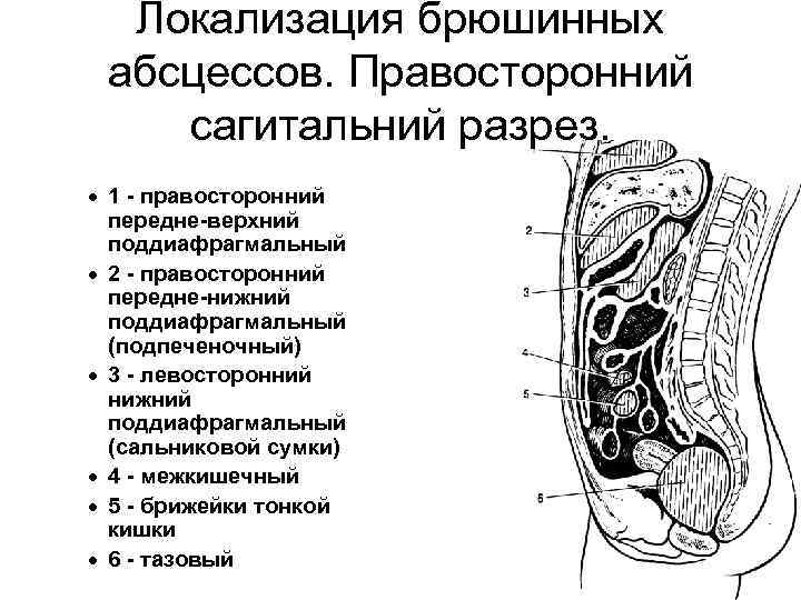 Локализация брюшинных абсцессов. Правосторонний сагитальний разрез. · 1 - правосторонний передне-верхний поддиафрагмальный · 2