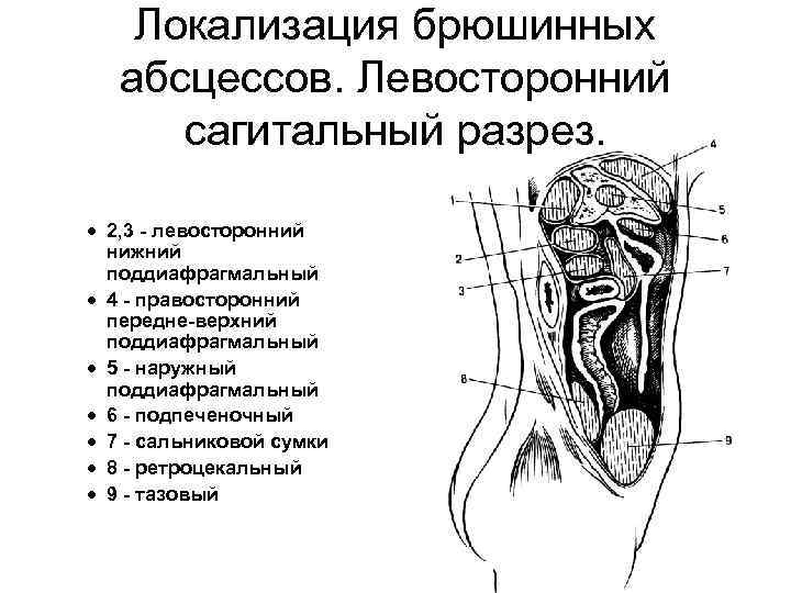 Локализация брюшинных абсцессов. Левосторонний сагитальный разрез. · 1 - левосторонний верхний поддиафрагмальный · 2,