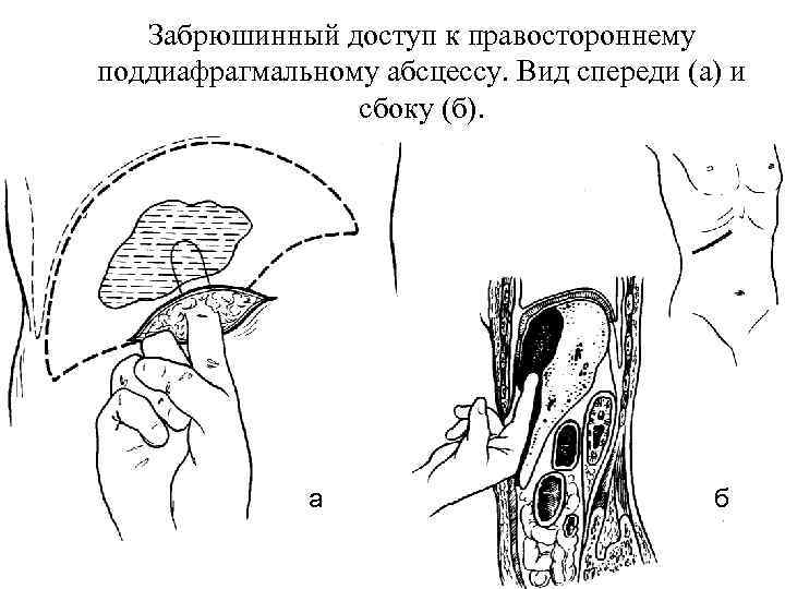 Забрюшинный доступ к правостороннему поддиафрагмальному абсцессу. Вид спереди (а) и сбоку (б). а б