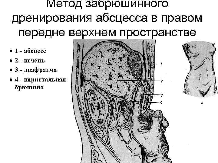 Метод забрюшинного дренирования абсцесса в правом передне верхнем пространстве · · 1 - абсцесс