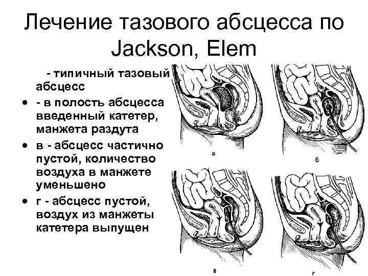 Лечение тазового абсцесса по Jackson, Elem · а - типичный тазовый абсцесс · -