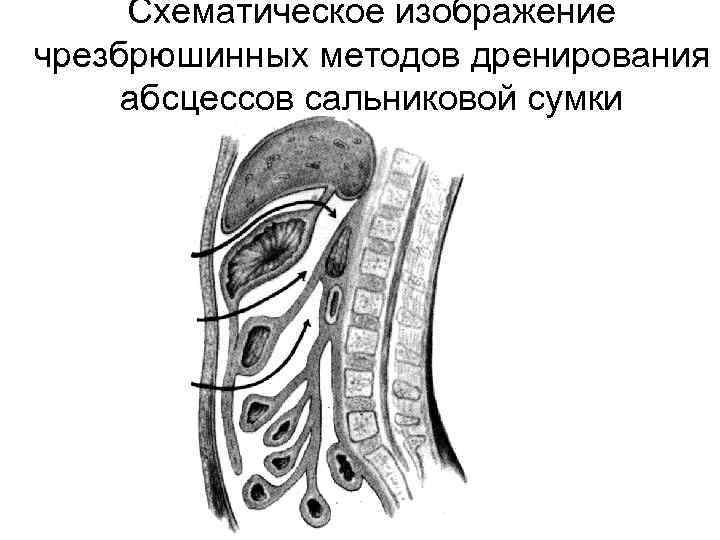 Схематическое изображение чрезбрюшинных методов дренирования абсцессов сальниковой сумки 