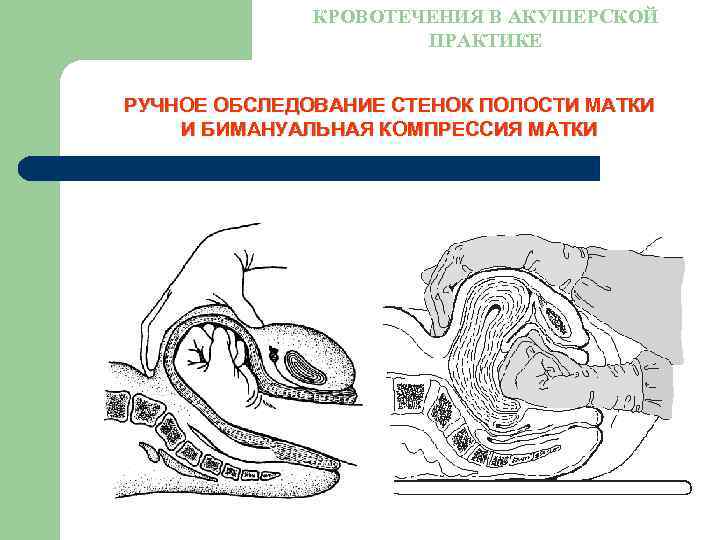 Акушерское кровотечение картинки