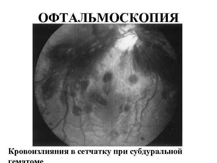 ОФТАЛЬМОСКОПИЯ Кровоизлияния в сетчатку при субдуральной 