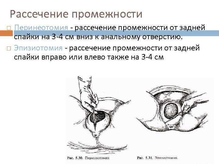 Рассечение промежности Перинеотомия - рассечение промежности от задней спайки на 3 -4 см вниз