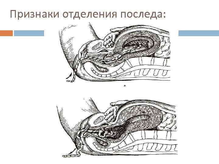 Признаки отделения последа: 