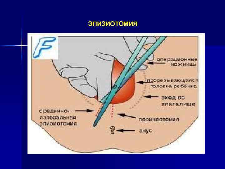 ЭПИЗИОТОМИЯ 