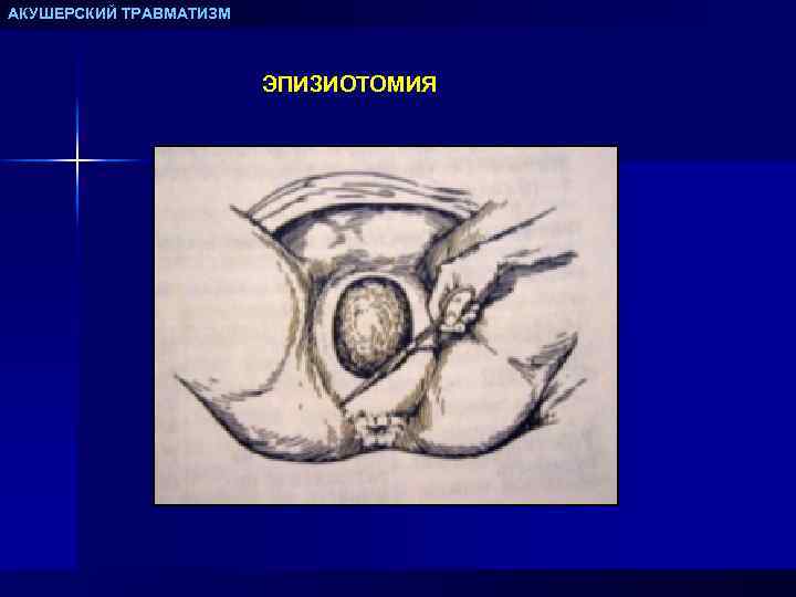 АКУШЕРСКИЙ ТРАВМАТИЗМ ЭПИЗИОТОМИЯ 