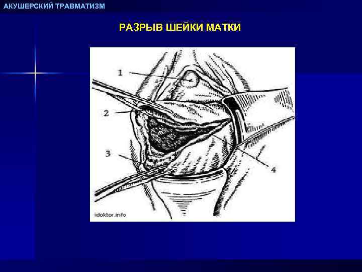 АКУШЕРСКИЙ ТРАВМАТИЗМ РАЗРЫВ ШЕЙКИ МАТКИ 