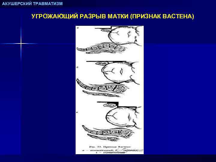 АКУШЕРСКИЙ ТРАВМАТИЗМ УГРОЖАЮЩИЙ РАЗРЫВ МАТКИ (ПРИЗНАК ВАСТЕНА) 