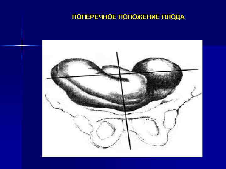 ПОПЕРЕЧНОЕ ПОЛОЖЕНИЕ ПЛОДА 