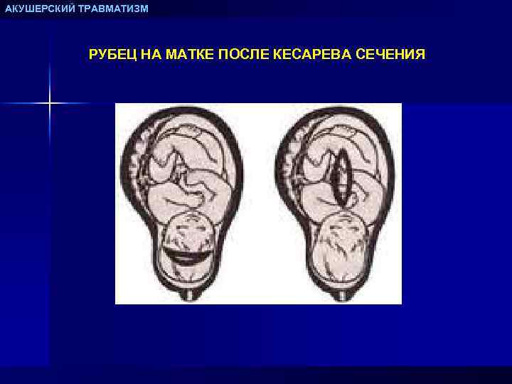 АКУШЕРСКИЙ ТРАВМАТИЗМ РУБЕЦ НА МАТКЕ ПОСЛЕ КЕСАРЕВА СЕЧЕНИЯ 