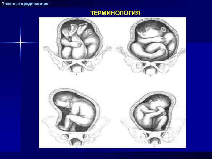 Тазовые предлежания ТЕРМИНОЛОГИЯ 