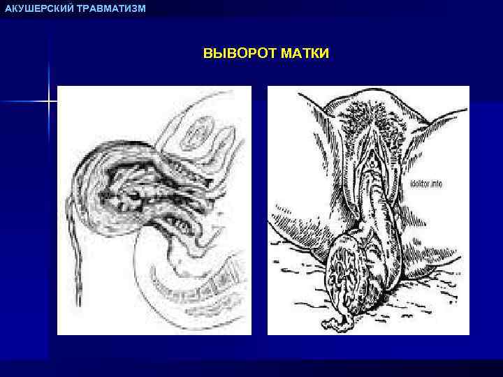 АКУШЕРСКИЙ ТРАВМАТИЗМ ВЫВОРОТ МАТКИ 