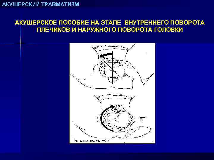 АКУШЕРСКИЙ ТРАВМАТИЗМ АКУШЕРСКОЕ ПОСОБИЕ НА ЭТАПЕ ВНУТРЕННЕГО ПОВОРОТА ПЛЕЧИКОВ И НАРУЖНОГО ПОВОРОТА ГОЛОВКИ 