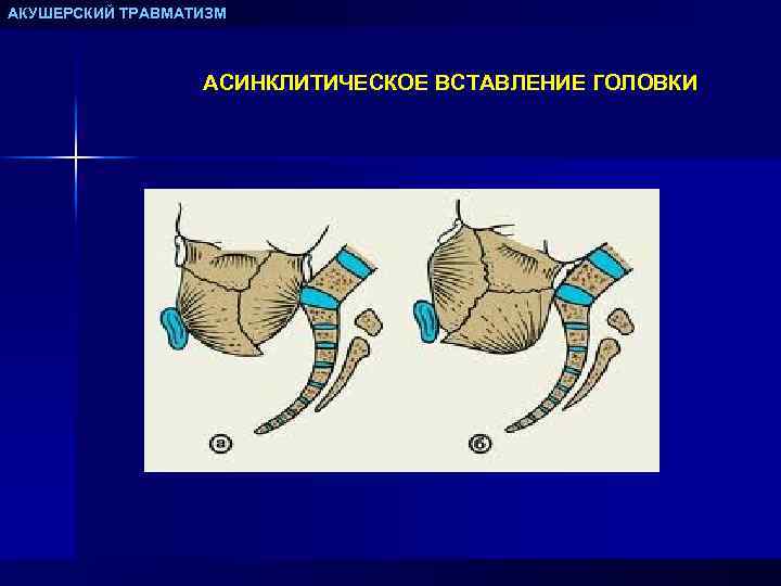 АКУШЕРСКИЙ ТРАВМАТИЗМ АСИНКЛИТИЧЕСКОЕ ВСТАВЛЕНИЕ ГОЛОВКИ 