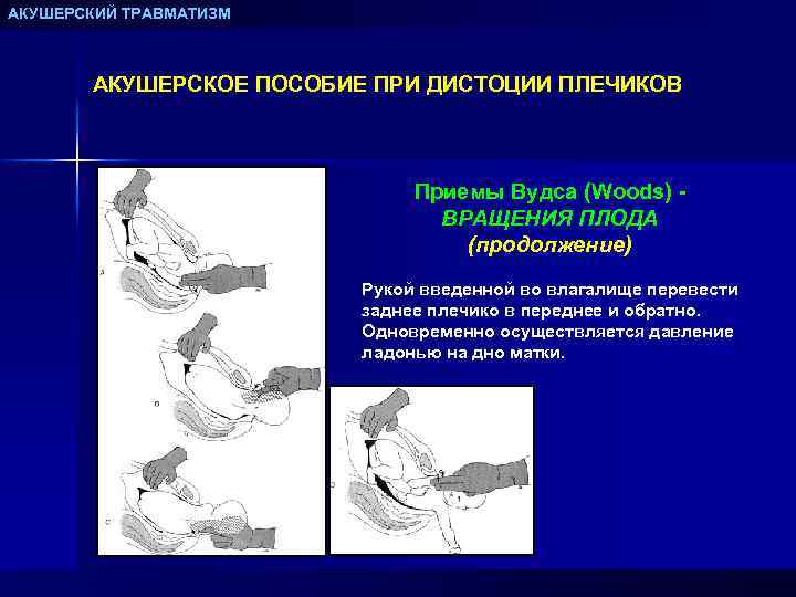 АКУШЕРСКИЙ ТРАВМАТИЗМ АКУШЕРСКОЕ ПОСОБИЕ ПРИ ДИСТОЦИИ ПЛЕЧИКОВ Приемы Вудса (Woods) ВРАЩЕНИЯ ПЛОДА (продолжение) Рукой