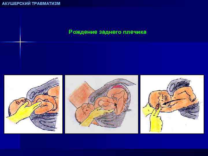 АКУШЕРСКИЙ ТРАВМАТИЗМ Рождение заднего плечика 