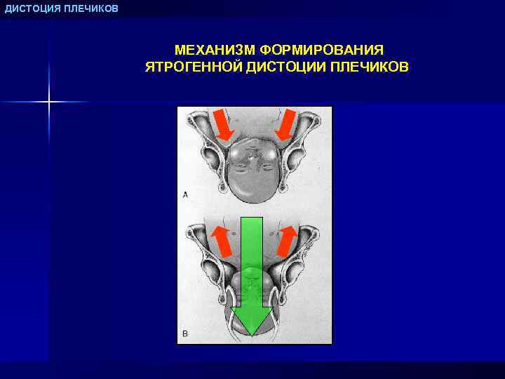 ДИСТОЦИЯ ПЛЕЧИКОВ МЕХАНИЗМ ФОРМИРОВАНИЯ ЯТРОГЕННОЙ ДИСТОЦИИ ПЛЕЧИКОВ 