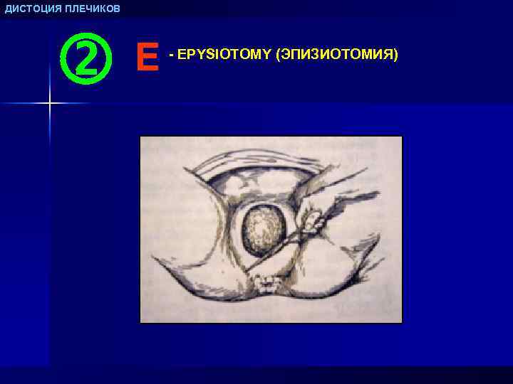 ДИСТОЦИЯ ПЛЕЧИКОВ E - EPYSIOTOMY (ЭПИЗИОТОМИЯ) 