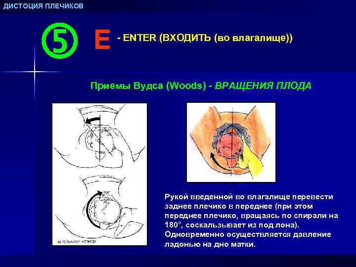 ДИСТОЦИЯ ПЛЕЧИКОВ E - ENTER (ВХОДИТЬ (во влагалище)) Приемы Вудса (Woods) - ВРАЩЕНИЯ ПЛОДА