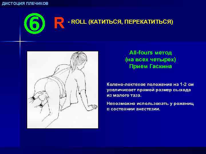 ДИСТОЦИЯ ПЛЕЧИКОВ R - ROLL (КАТИТЬСЯ, ПЕРЕКАТИТЬСЯ) All-fours метод (на всех четырех) Прием Гаскина