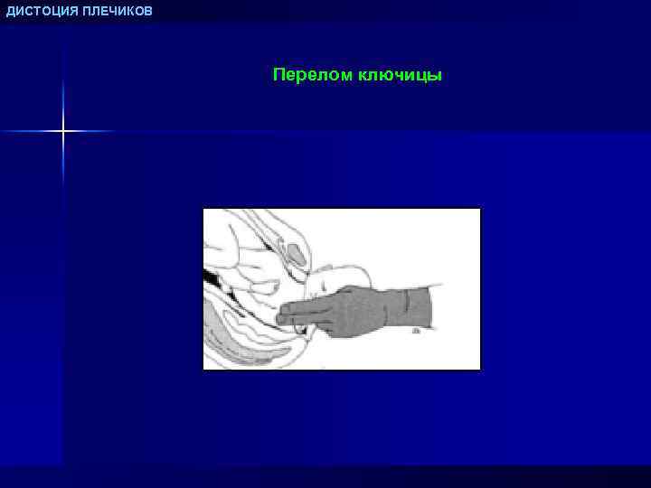 ДИСТОЦИЯ ПЛЕЧИКОВ Перелом ключицы 