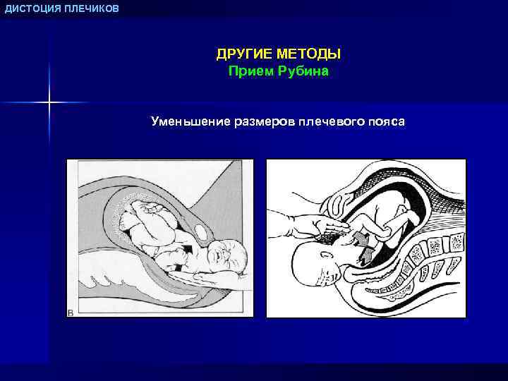 ДИСТОЦИЯ ПЛЕЧИКОВ ДРУГИЕ МЕТОДЫ Прием Рубина Уменьшение размеров плечевого пояса 