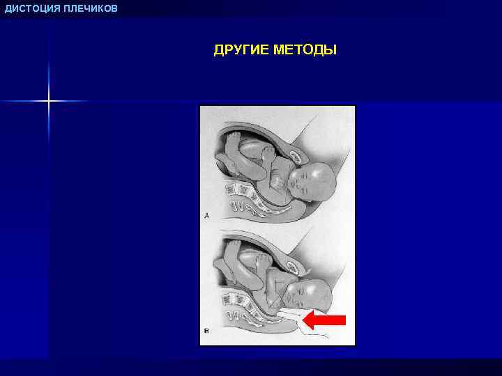 ДИСТОЦИЯ ПЛЕЧИКОВ ДРУГИЕ МЕТОДЫ 