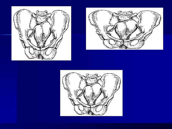 Анатомический узкий таз в акушерстве презентация