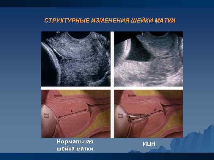 СТРУКТУРНЫЕ ИЗМЕНЕНИЯ ШЕЙКИ МАТКИ Нормальная шейка матки ИЦН 