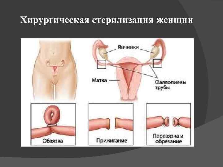 Хирургическая стерилизация женщин 