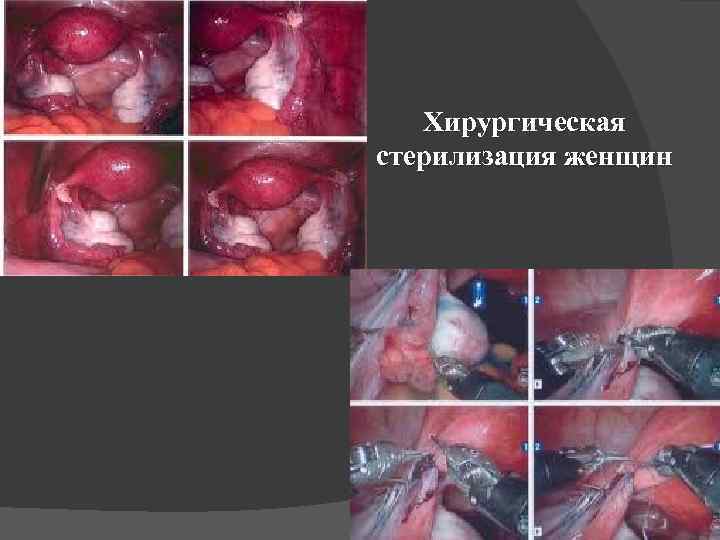 Хирургическая стерилизация женщин 