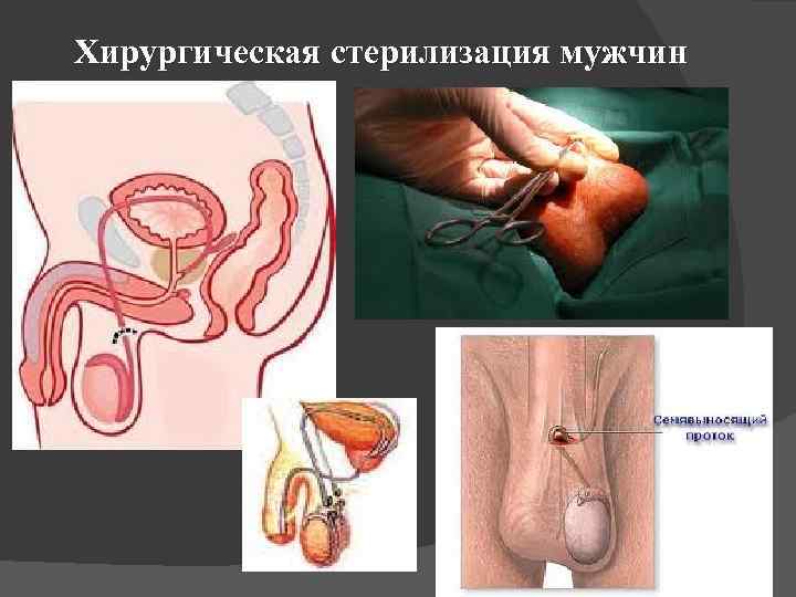 Хирургическая стерилизация мужчин 