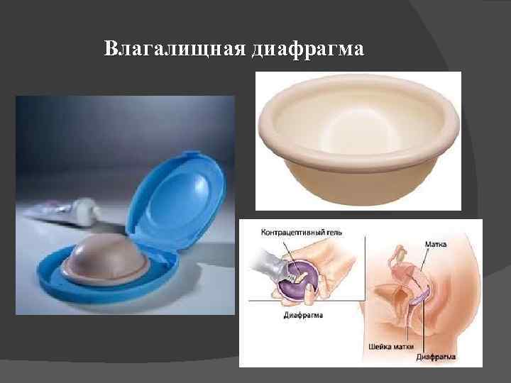 Влагалищная диафрагма 