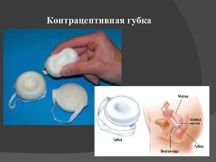 Контрацептивная губка 