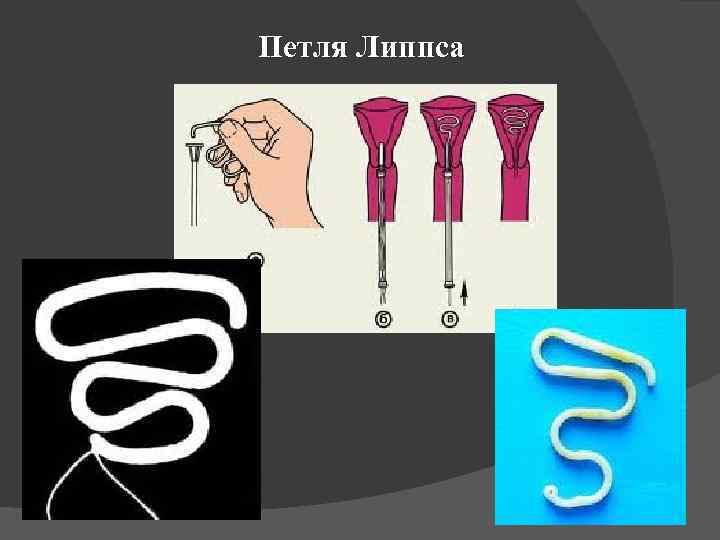 Петля Липпса 